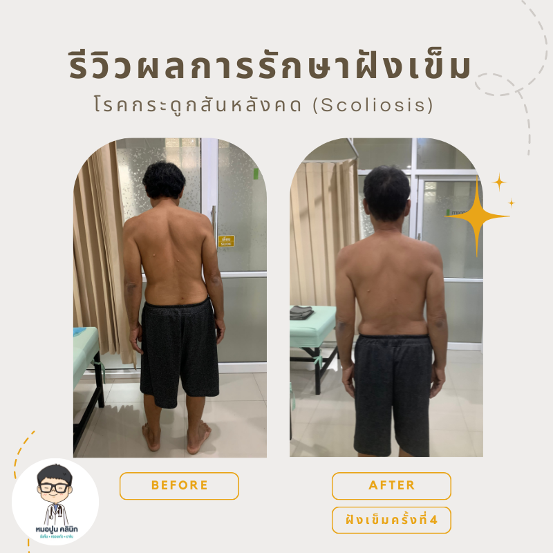 โรคกระดูกสันหลังคด Scoliosis