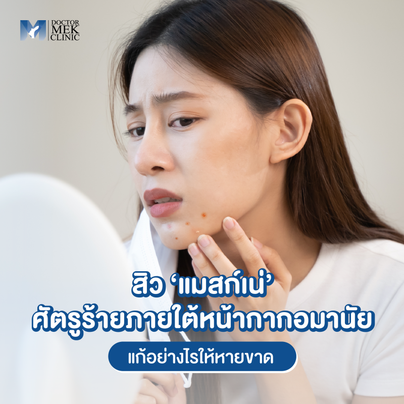 สิว ‘แมสก์เน่’ ศัตรูร้ายภายใต้หน้ากากอมานัย แก้อย่างไรให้หายขาด