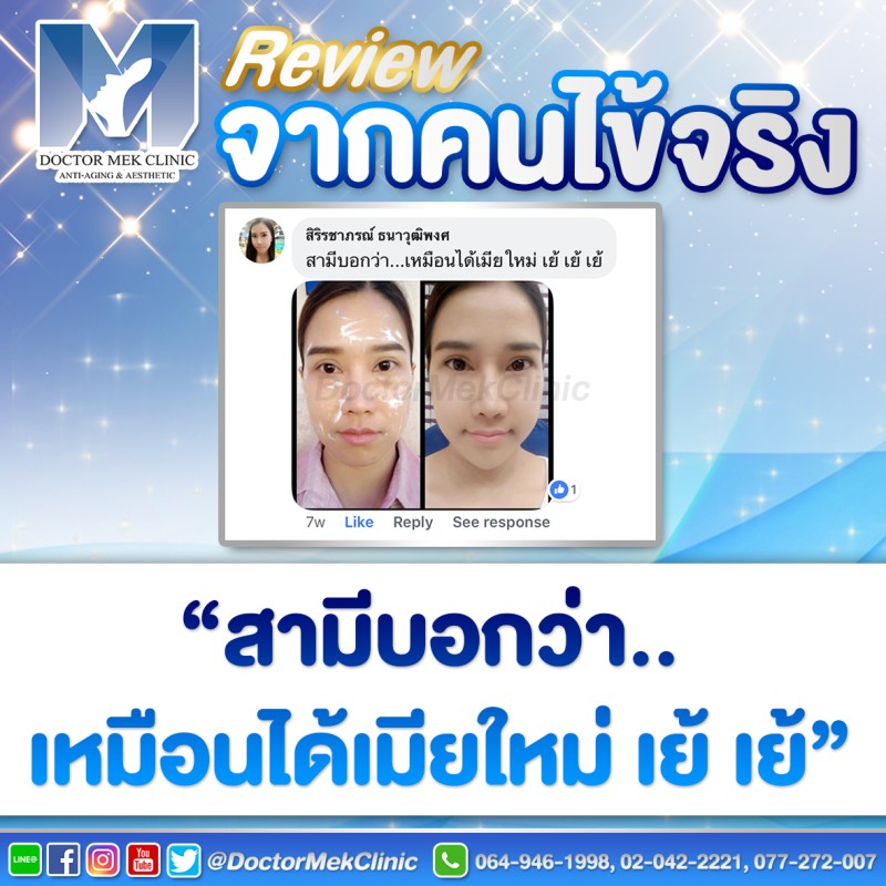 รีวิวฟิลเลอร์ใต้ตา