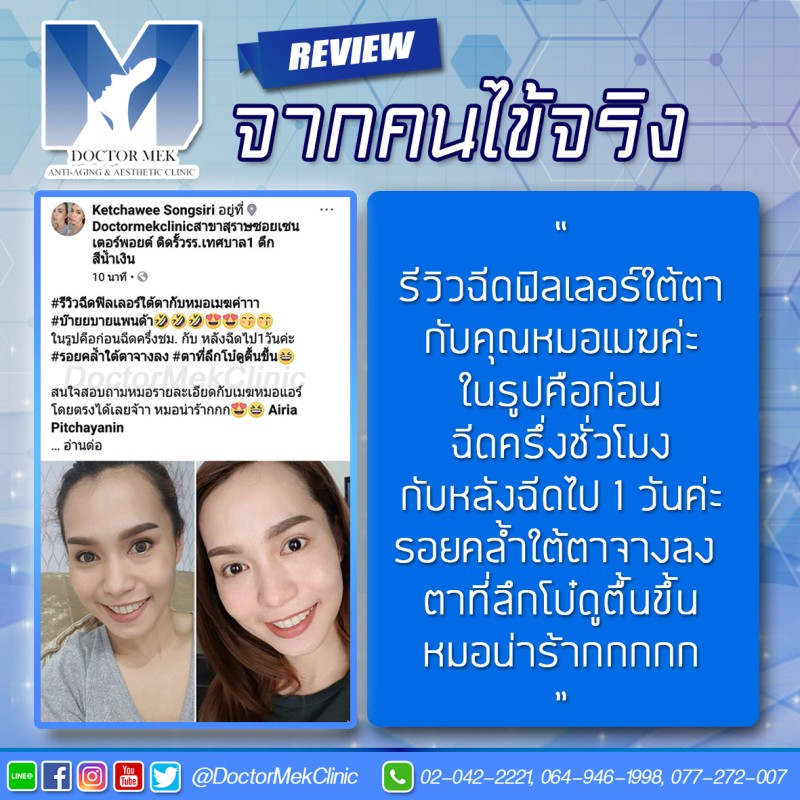 รีวิวฟิลเลอร์ใต้ตา