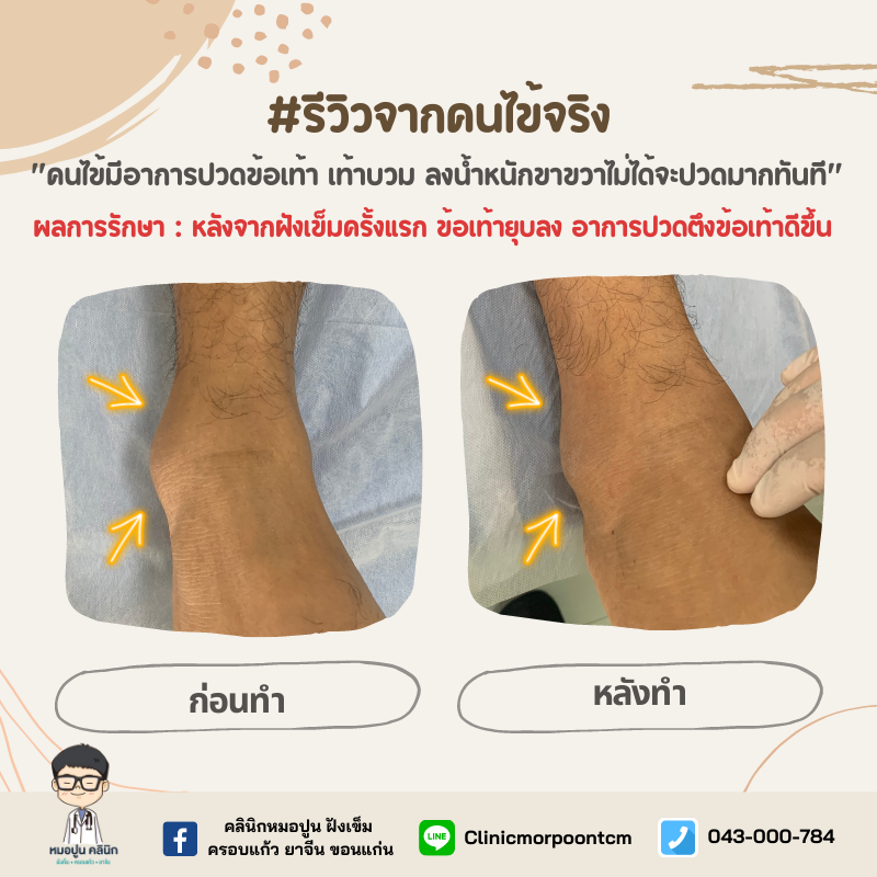 รีวิว ข้อเท้าบวม ปวดข้อเท้า 