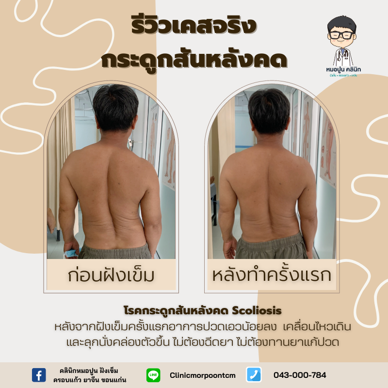 รีวิว คนไข้กระดูกสันหลังคด