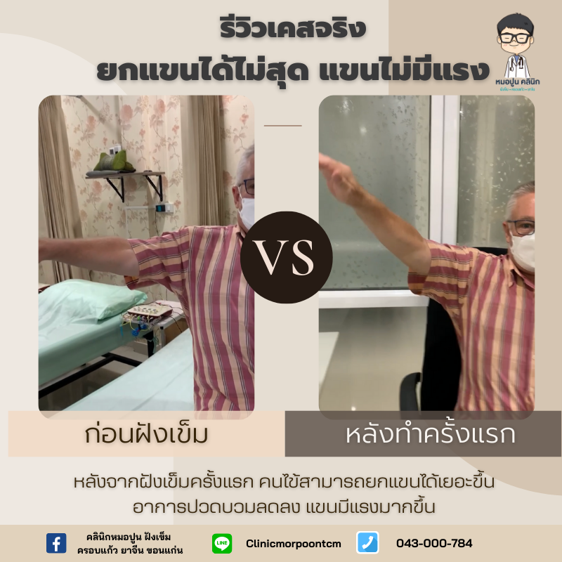 รีวิว ปวดหัวไหล่ยกแขนไม่ขึ้น