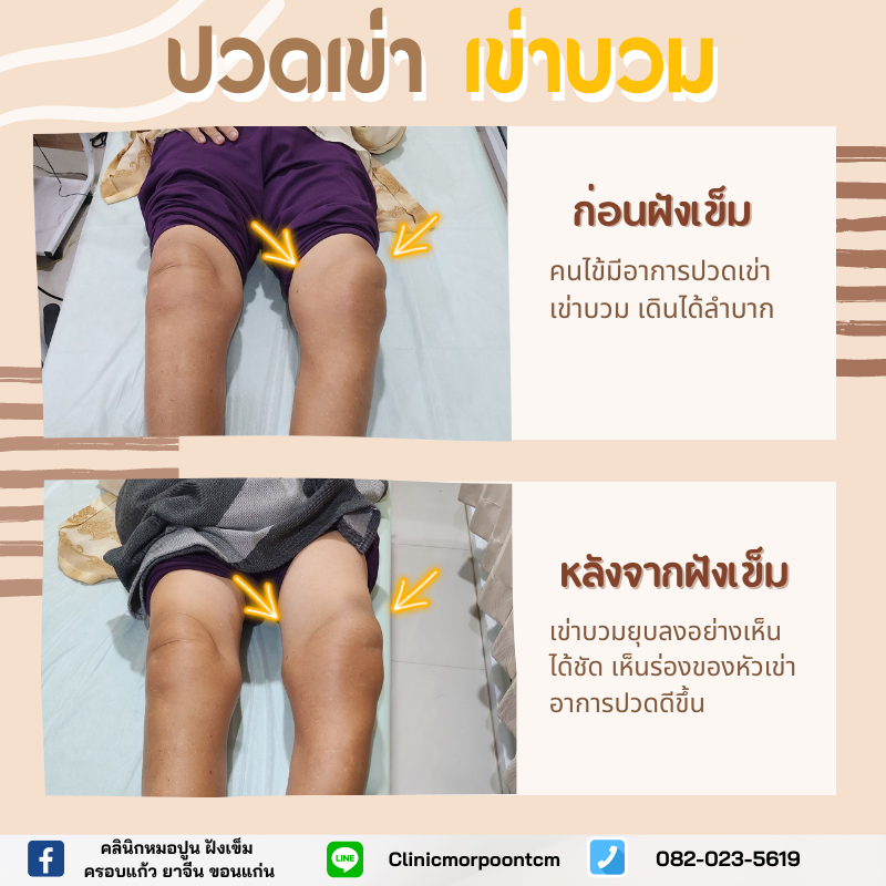 รีวิวปวดเข่า เข่าบวม